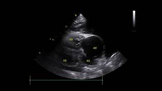 Eisenmengers syndrome and an atrial septal defect in young 🐈 [upl. by Daph]