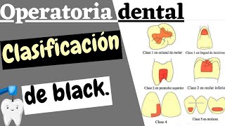 CLASIFICACIÓN DE LAS CAVIDADES DENTALES SEGUN BLACK  CARIES DENTAL EXPLICADA FACIL [upl. by Ashien]