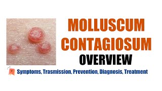 Molluscum Contagiosum Water warts Symptoms transmission prevention diagnosis treatment [upl. by Estren747]