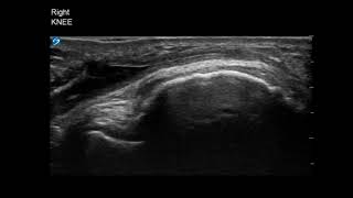 Knee Ultrasound Infrapatellar Bursitis Aspiration Part 3 [upl. by Coucher]