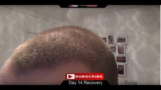 FUE Hair Transplant Day 14 Post Op Recovery [upl. by Noyr959]