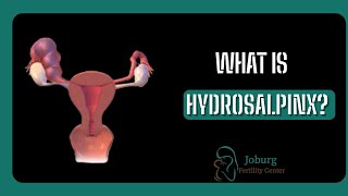 WHAT IS HYDROSALPINX [upl. by Maitund]