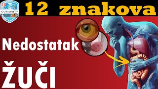 12 znakova Nedostatak žuči u crijevu Dr113 [upl. by Repsac503]