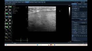 IQ 305 LIVER ULTRASOUND ECHOPAC ANALYSIS HEPATOMA [upl. by Eon]