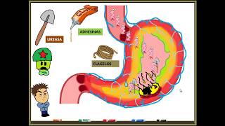 HELICOBACTER PYLORI GASTRITIS [upl. by Nav]