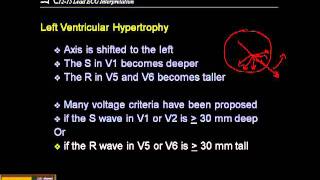 1215 Lead ECG Ventricular Hypertrophy [upl. by Araminta745]