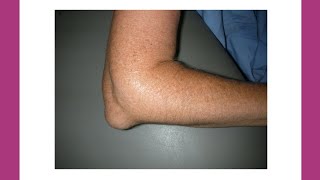 What is Olecranon Bursitis  shorts [upl. by Bernat608]