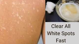 Apply This On Skin to Clear WHITE SPOTS  WHITE PATCHES VITILIGO  CREAM REACTION [upl. by Dnartreb]