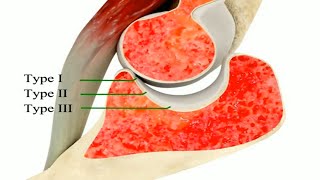 Classification of Coronoid fracture [upl. by Yrffej]