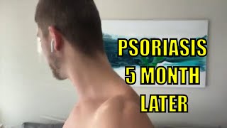 Psoriasis Cleared Up 5 Month Update [upl. by Ewnihc910]