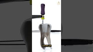 Root Canal Success The Importance of Proper Filling [upl. by Noiro]