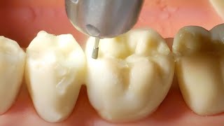 Composite Preparation Walkthrough for 19 MO Approximal Box and Occlusal Fill [upl. by Drawoh977]