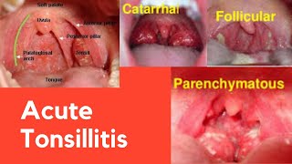 Acute tonsillitis  ENT Dhingra [upl. by Glenden447]