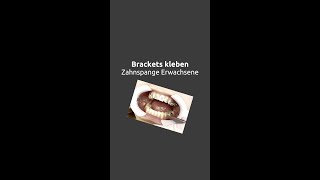 Zahnspange Erwachsene  Brackets kleben shorts [upl. by Hart]