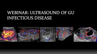 Webinar Ultrasound of Genitourinary Infectious Disease [upl. by Lexi]