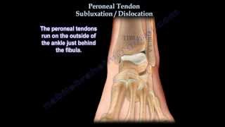 Peroneal Tendon Subluxation  Dislocation  Everything You Need To Know  Dr Nabil Ebraheim [upl. by Lynnworth]