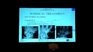 Arthroscopic Scaphoid Trapezium Trapezoid arthritis treatment [upl. by Frederico]