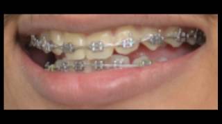 braces time lapse orthodontic treatment [upl. by Carie513]