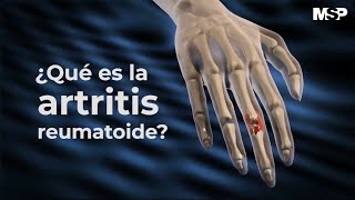 Artritis Reumatoide  ExclusivoMSP [upl. by Erdei]