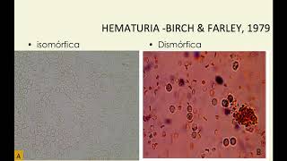 Glomerulopatias  Raciocínio Clínico  Drª Patrícia Abreu [upl. by Poore]