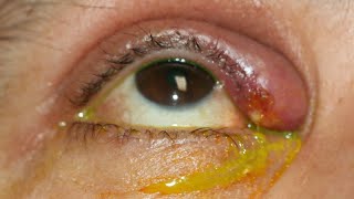 Eye lid infection condition explained indetail eyecareoptom [upl. by Ailedroc82]