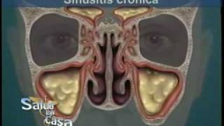 Cirugía de Sinusitis Relación con septo nasal y cornetes [upl. by Scoville]