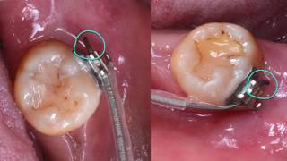 Clinical Tip How to Secure the Wire End by Dr Ashley Huang｜【Chris Chang Ortho】CC427 [upl. by Kee]