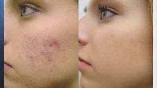 Acne Treatment with Fotona Laser [upl. by Hesketh914]