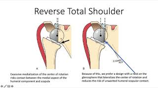 How To Do a Reverse Total Shoulder 1 Component Selection [upl. by Urbai]