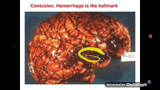 CNS Pathology II [upl. by Yenitsed897]