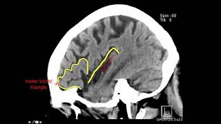 Introduction to Brain Surface Anatomy [upl. by Ardme]