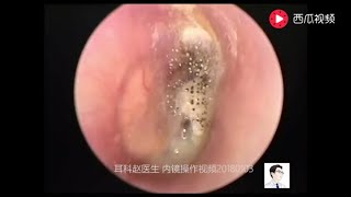 Earwax Removal ExtractionCerumen airtight 13 minutes [upl. by Anzovin]