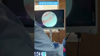 Elbow Dysplasia  Under Arthroscopy [upl. by Merras]