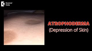 Atrophoderma is curable or not  Depression of Skin  What is this DrNischal K  Doctors Circle [upl. by Jobi]