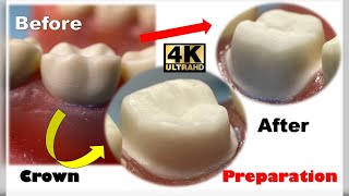 The Ultimate Crown Prep Tutorial Lower First Molar Made Easy [upl. by Artim777]