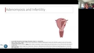 Endometriosis and Adenomyosis impact on Implantation  L Henry Liege [upl. by Boony733]