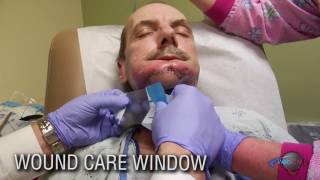 Wound Care Window Oral Cutaneous Fistula [upl. by Nireves]