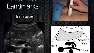 Kidney and Bladder Ultrasound elearning [upl. by Ditmore739]