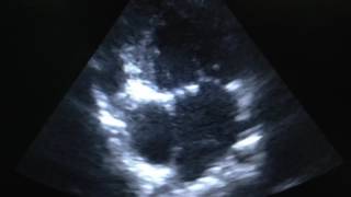 Tricuspid Atresia Echocardiogram [upl. by Masry]