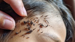 How to remove all of big lice from hair  Getting out many head lice [upl. by Euginom]