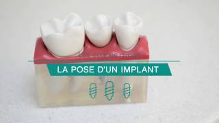 Tout savoir sur la pose dimplant [upl. by Htaek]