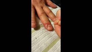 Lance or drain ingrown nail or infected cuticle [upl. by Nisaj895]