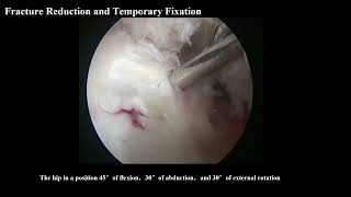 Arthroscopic Fixation With Absorbable Suture Anchors for Pipkin Type I Femoral Head Fractures—Letter [upl. by Nadler168]