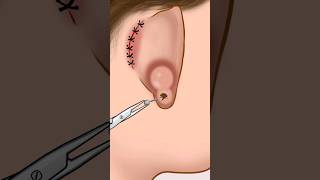 ASMR Infected ear piercing removal animation P2 animation asmr satisfying viral shorts [upl. by Acinorrev986]