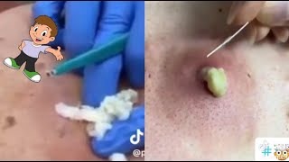 Ultimate Relaxing Acne amp Blackhead Removal Compilation  Satisfying Pimple Pops 2024 [upl. by Retsevlis]