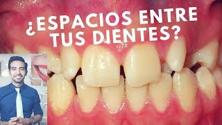 Cómo cerrar los espacios entre los dientes Diastemas dentales [upl. by Odnalor428]