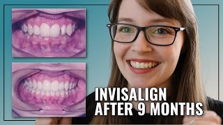 INVISALIGN BEFORE amp AFTER  Deep Bite  Crowding Treatment [upl. by Ennalyrehc]