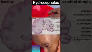 hydrocephalus  water in brain  awareness [upl. by Eziechiele312]