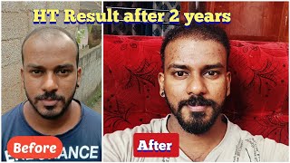 My Hair Transplantation Result after 2 years  Hair Transplantation Review Malayalam  ExoticBeast [upl. by Block472]