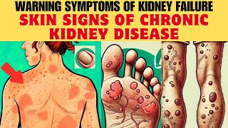 Skin Signs of CHRONIC KIDNEY DISEASE – Warning Symptoms of KIDNEY FAILURE You Need to Know [upl. by Clie112]